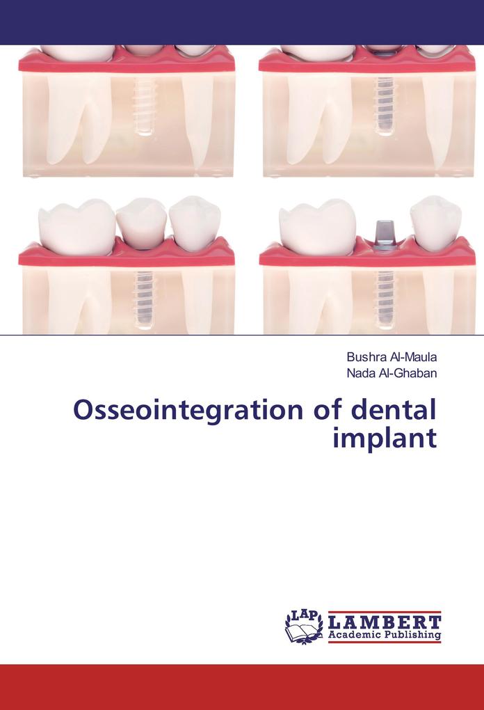 Osseointegration of dental implant als Buch von Bushra Al-Maula, Nada Al-Ghaban - Bushra Al-Maula, Nada Al-Ghaban