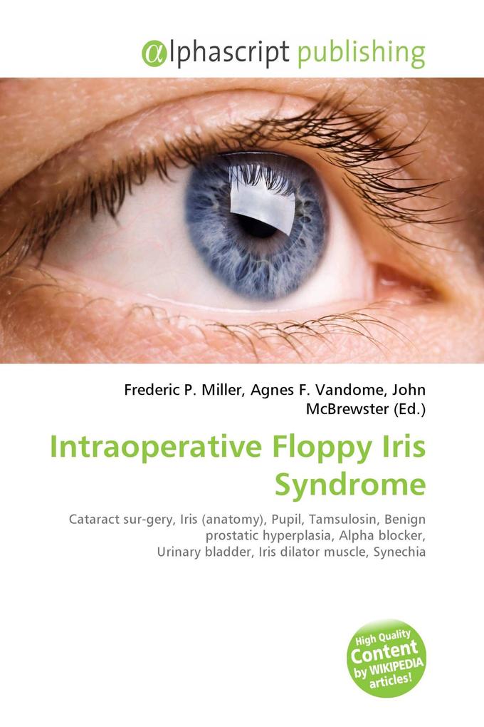 Intraoperative Floppy Iris Syndrome