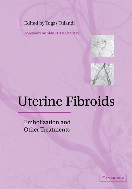 Uterine Fibroids