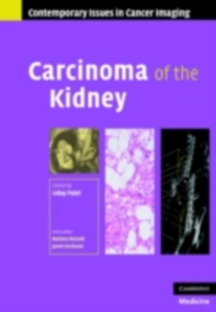Carcinoma of the Kidney