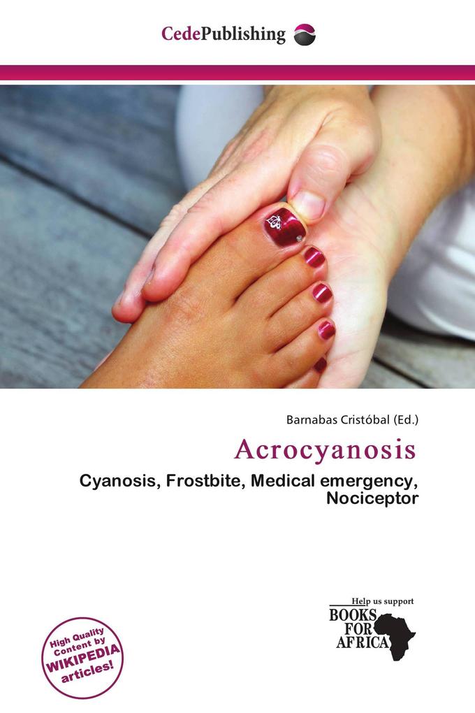 Acrocyanosis