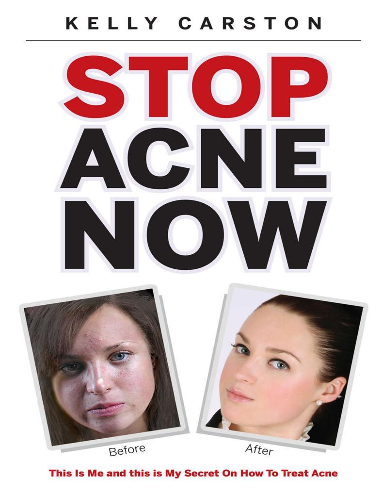 Stop Acne Now: This Is Me and This Is My Secret On How to Treat Acne