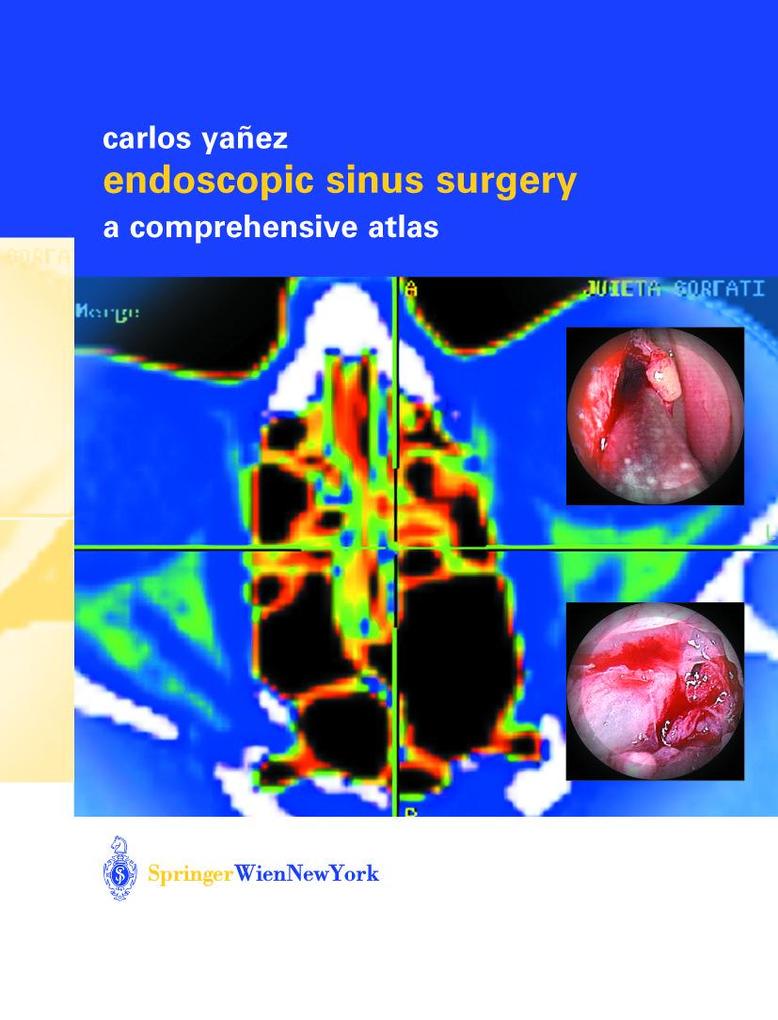 Endoscopic Sinus Surgery