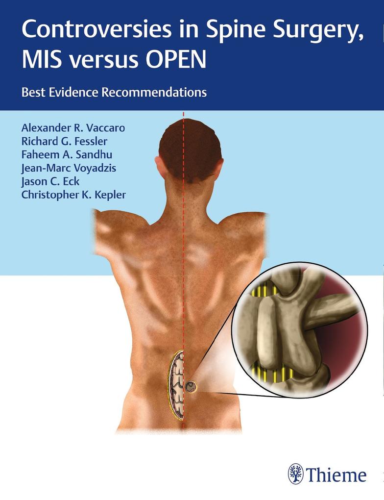 Thieme Publishers New York Controversies In Spine Surgery Mis Versus Open