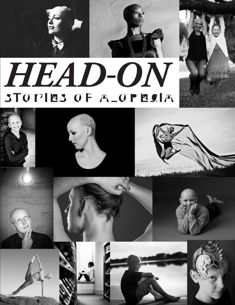Head-On Stories of Alopecia