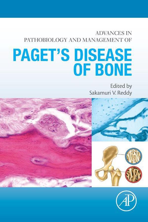 Advances in Pathobiology and Management of Paget‘s Disease of Bone