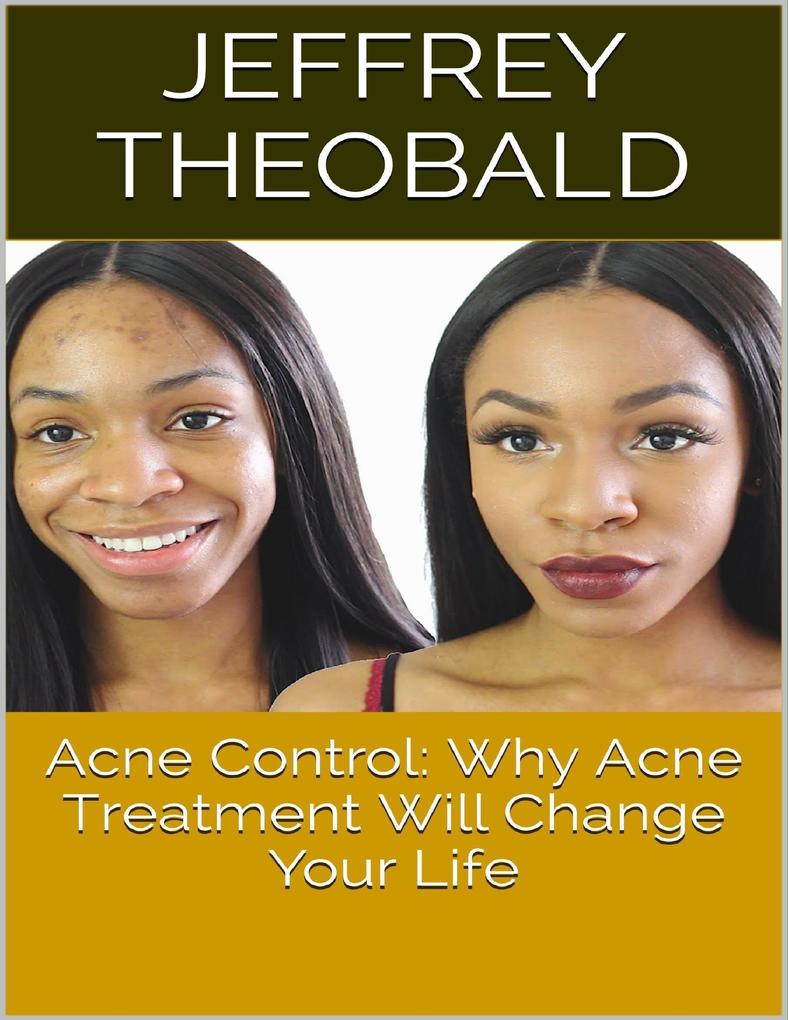 Acne Control: Why Acne Treatment Will Change Your Life