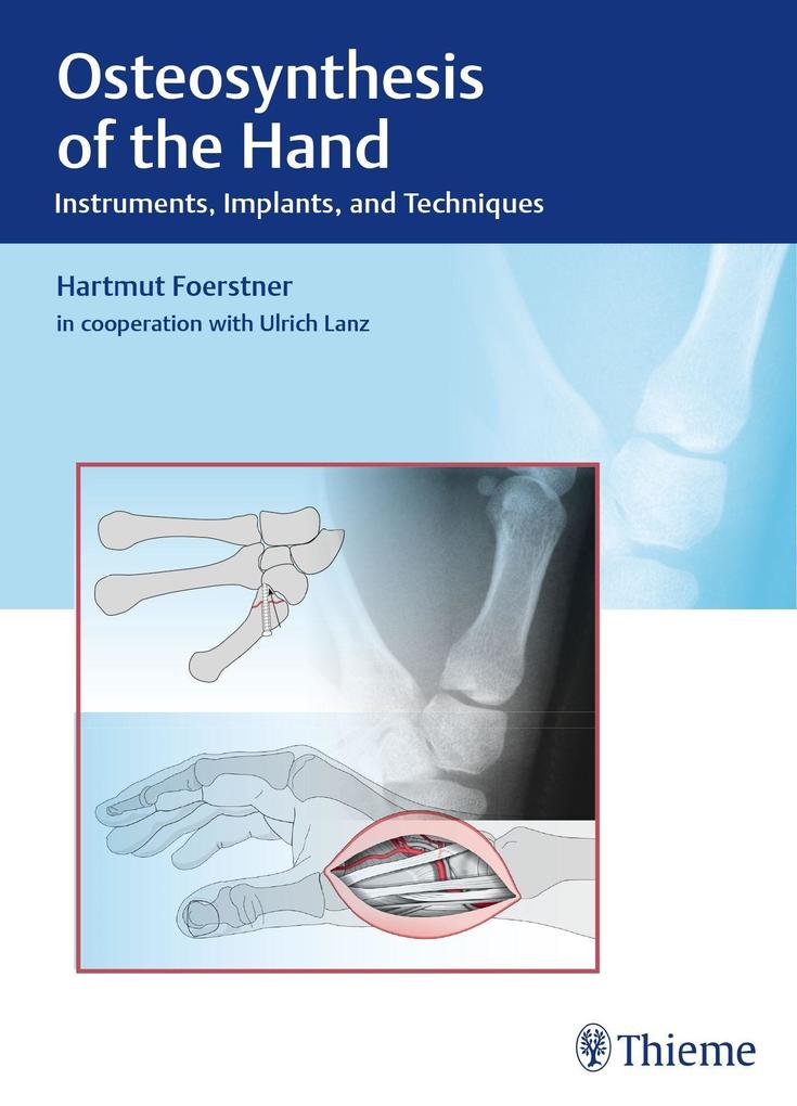 Osteosynthesis of the Hand - Hartmut Förstner/ Ulrich Lanz