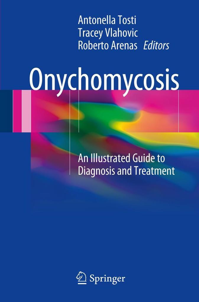 Onychomycosis