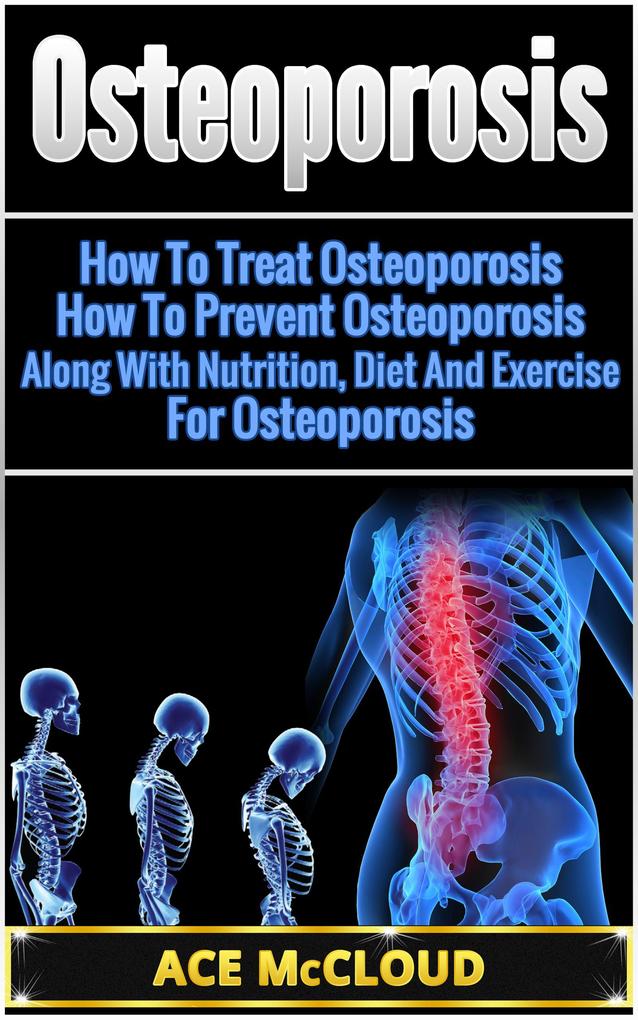 Osteoporosis: How To Treat Osteoporosis: How To Prevent Osteoporosis: Along With Nutrition Diet And Exercise For Osteoporosis