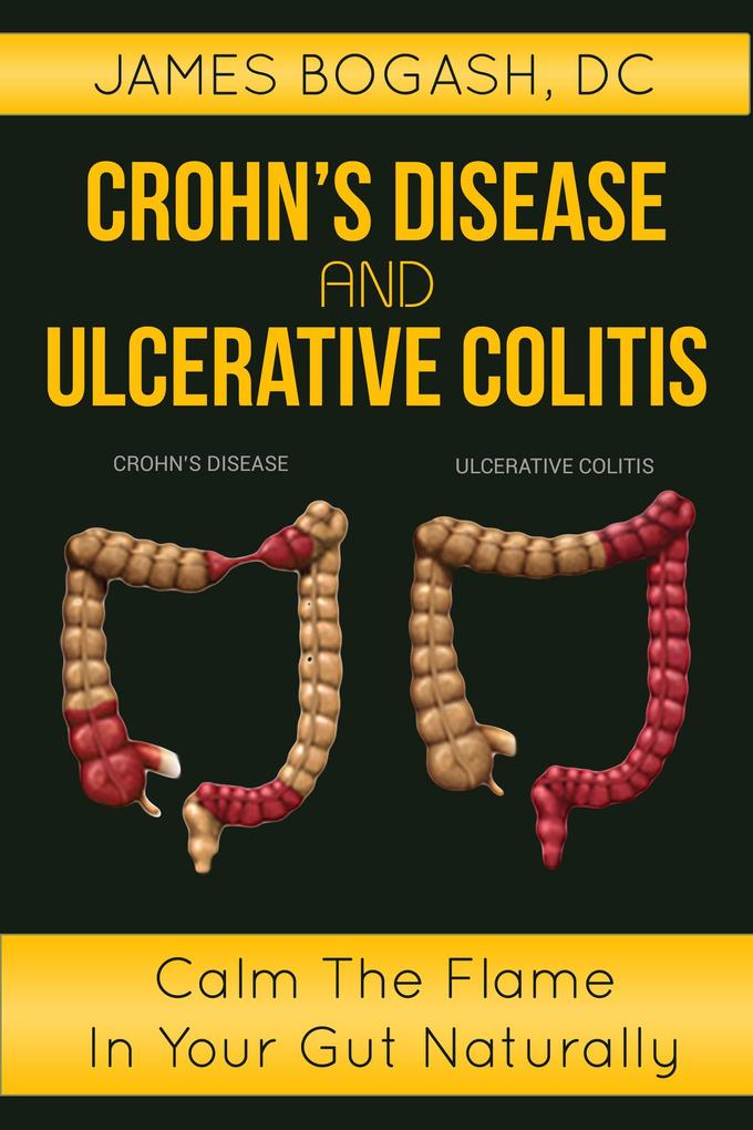 Crohn‘s Disease and Ulcerative Colitis: Calm the Flame in Your Gut Naturally