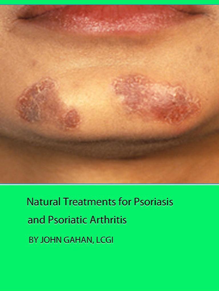 Natural Treatments for Psoriasis and Psoriatic Arthritis