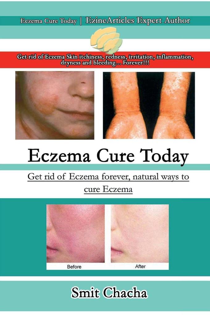 Eczema Cure Today - Get rid of Eczema forever natural ways to cure Eczema