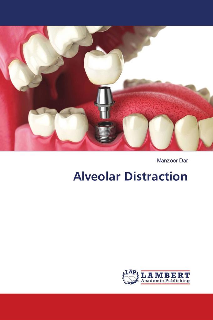 Alveolar Distraction