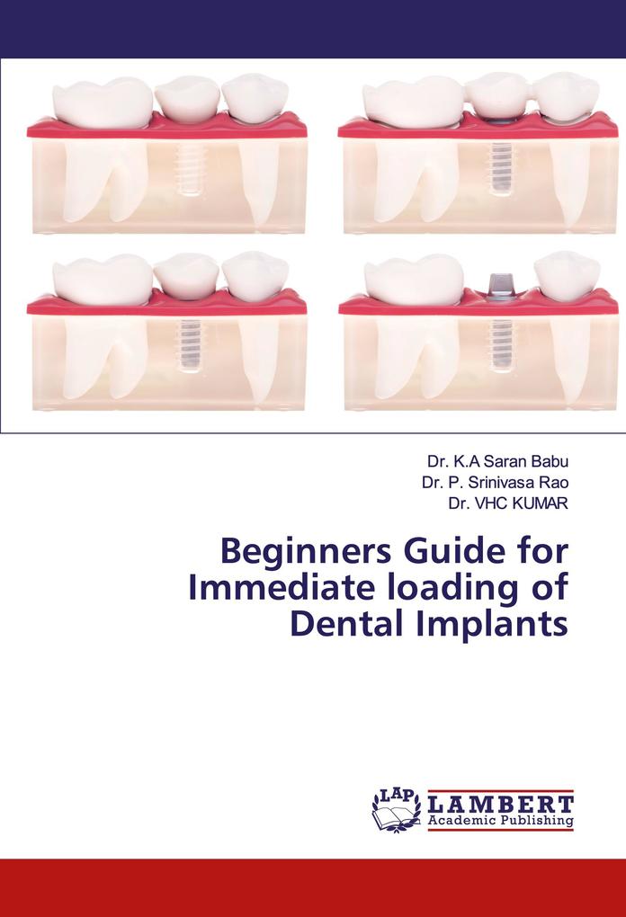 Beginners Guide for Immediate loading of Dental Implants