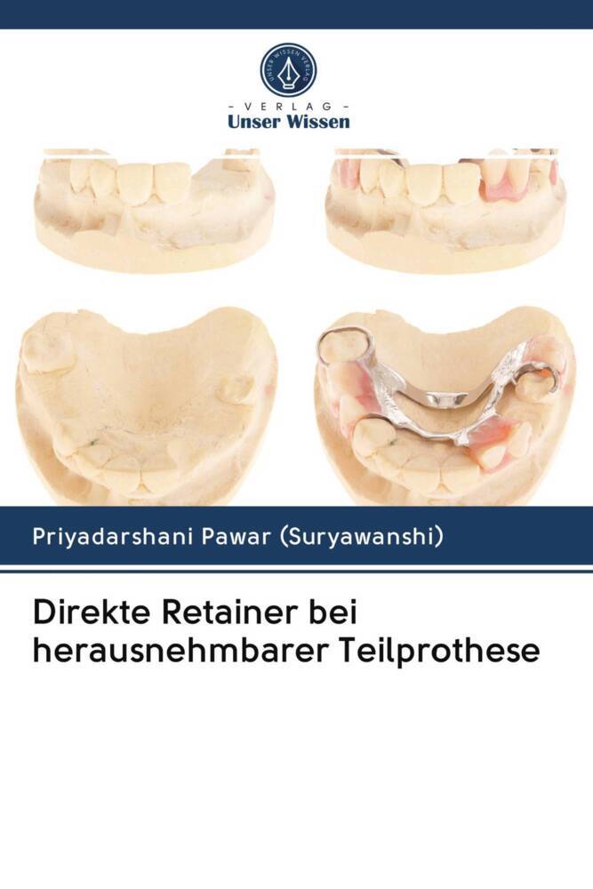 Direkte Retainer bei herausnehmbarer Teilprothese