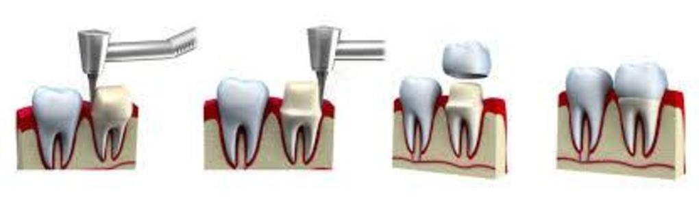 Getting A Dental Crown Procedure