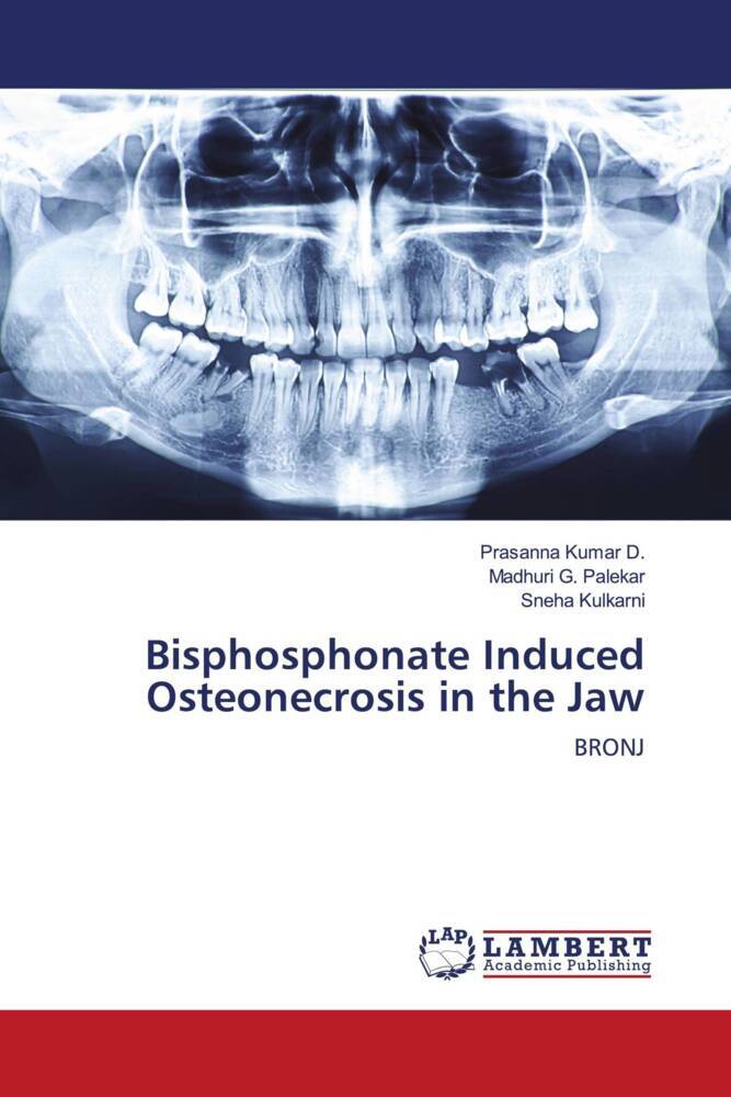 Bisphosphonate Induced Osteonecrosis in the Jaw