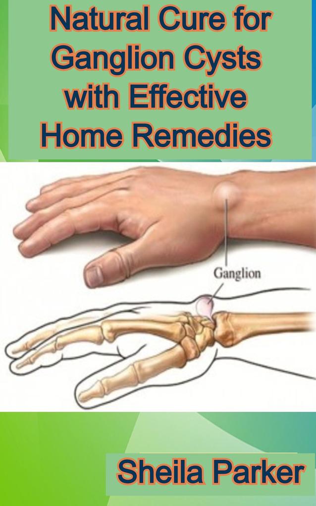 Natural Cure for Ganglion Cysts with Effective Home Remedies