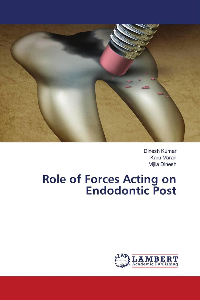Role of Forces Acting on Endodontic Post