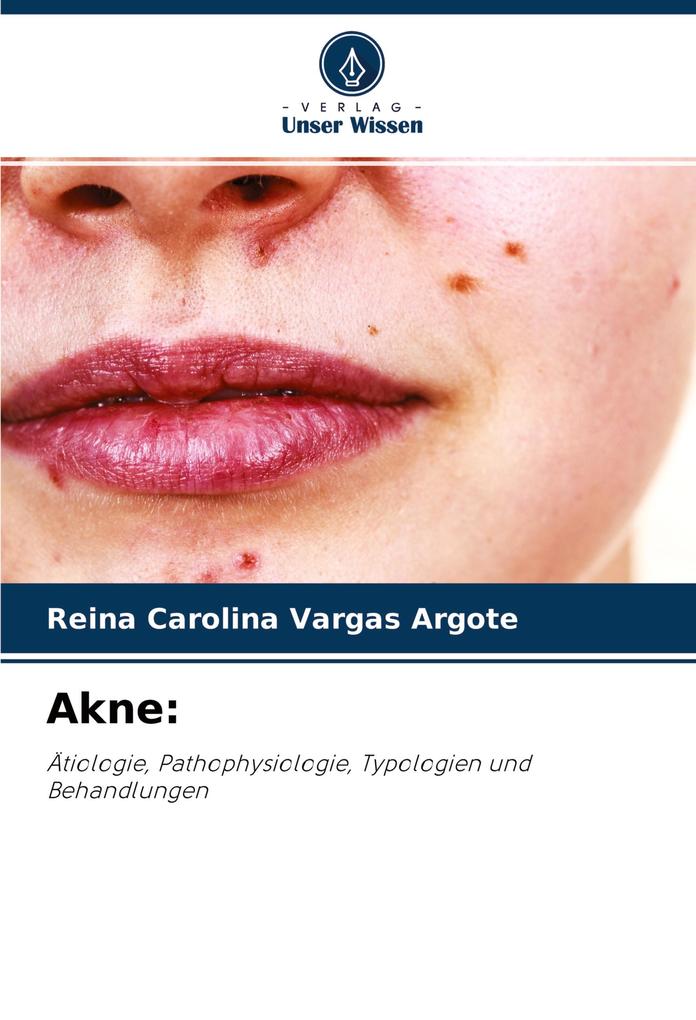 Akne: