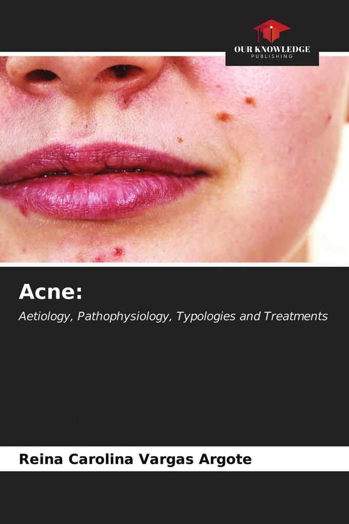 Acne: