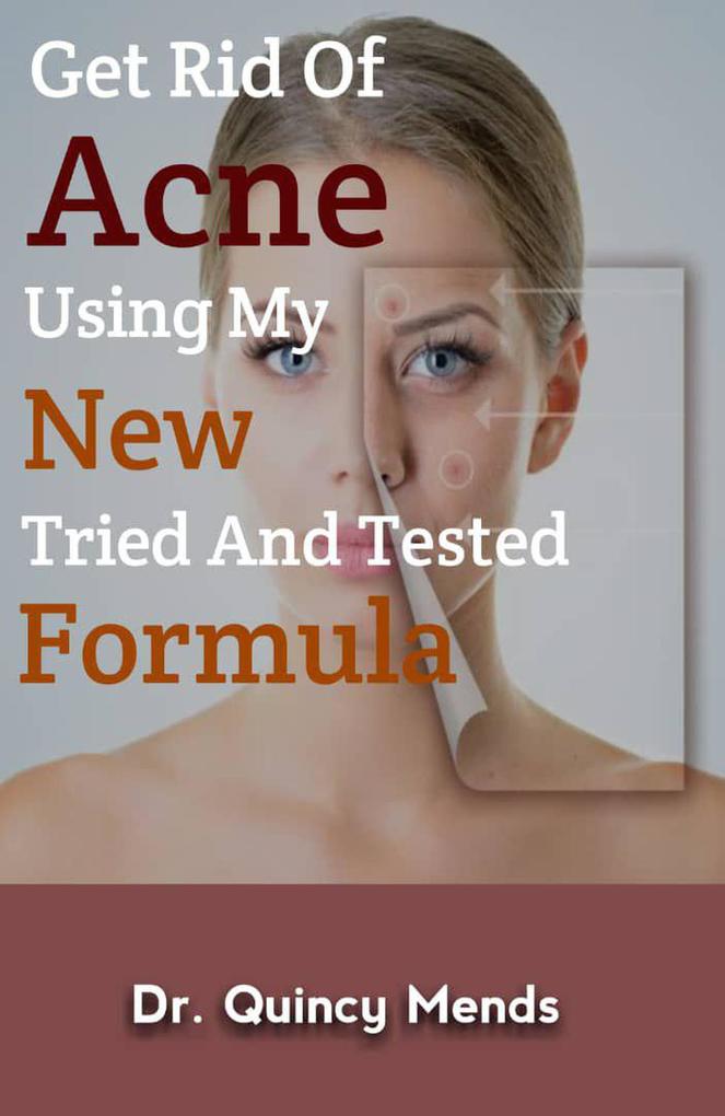 Get rid of acne using my new tried and tested formula
