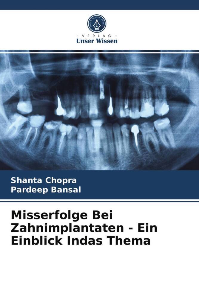 Misserfolge Bei Zahnimplantaten - Ein Einblick Indas Thema