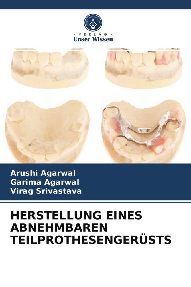 HERSTELLUNG EINES ABNEHMBAREN TEILPROTHESENGERÜSTS
