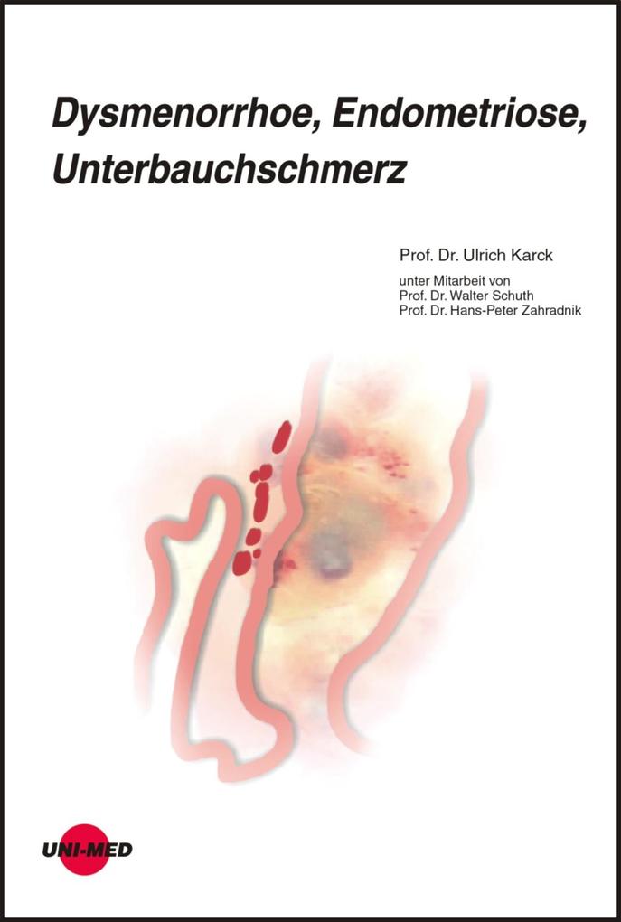 Dysmenorrhoe Endometriose Unterbauchschmerz