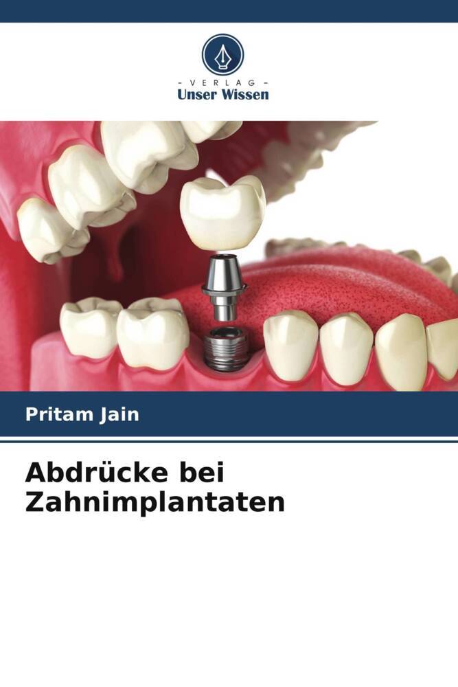 Abdrücke bei Zahnimplantaten