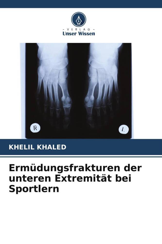 Ermüdungsfrakturen der unteren Extremität bei Sportlern