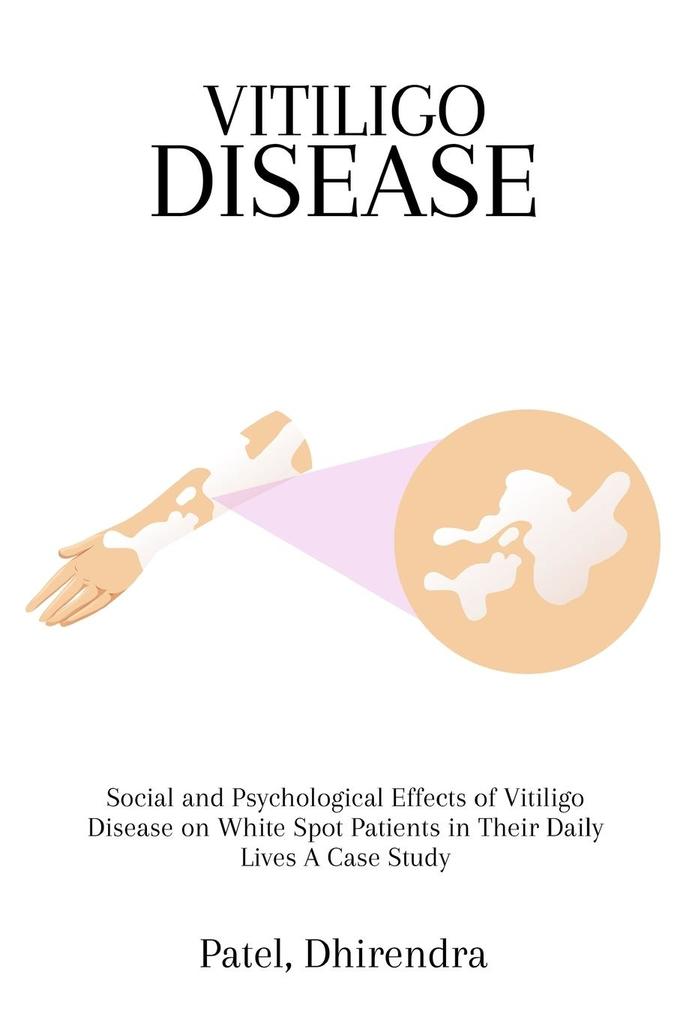 Social and Psychological Effects of Vitiligo Disease on White Spot Patients in Their Daily Lives A Case Study