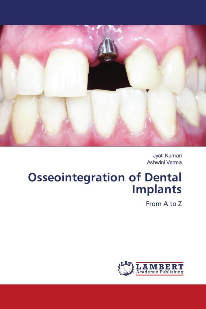 Osseointegration of Dental Implants