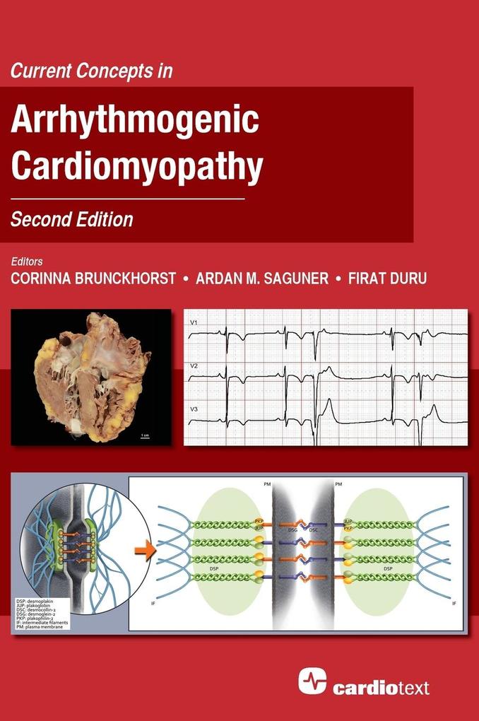 Current Concepts in Arrhythmogenic Cardiomyopathy Second Edition