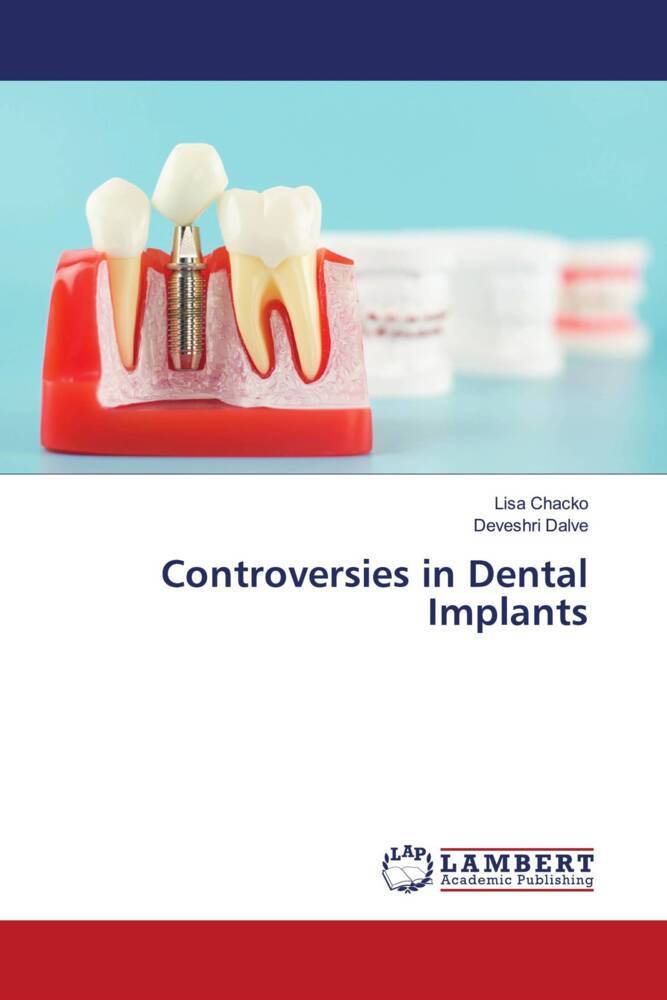 Controversies in Dental Implants