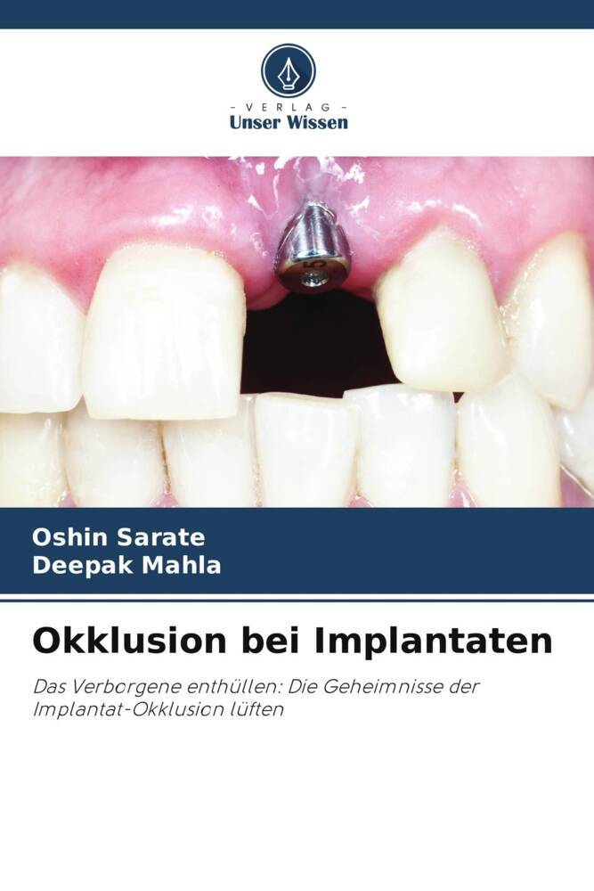 Okklusion bei Implantaten