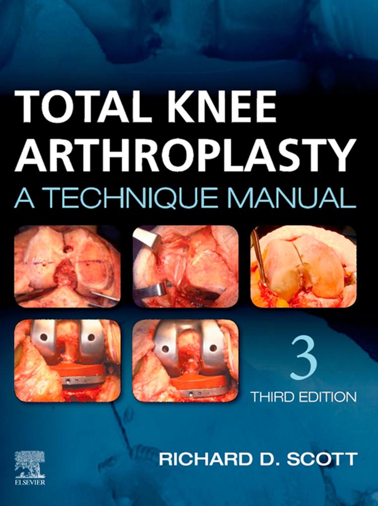 Total Knee Arthroplasty E-Book