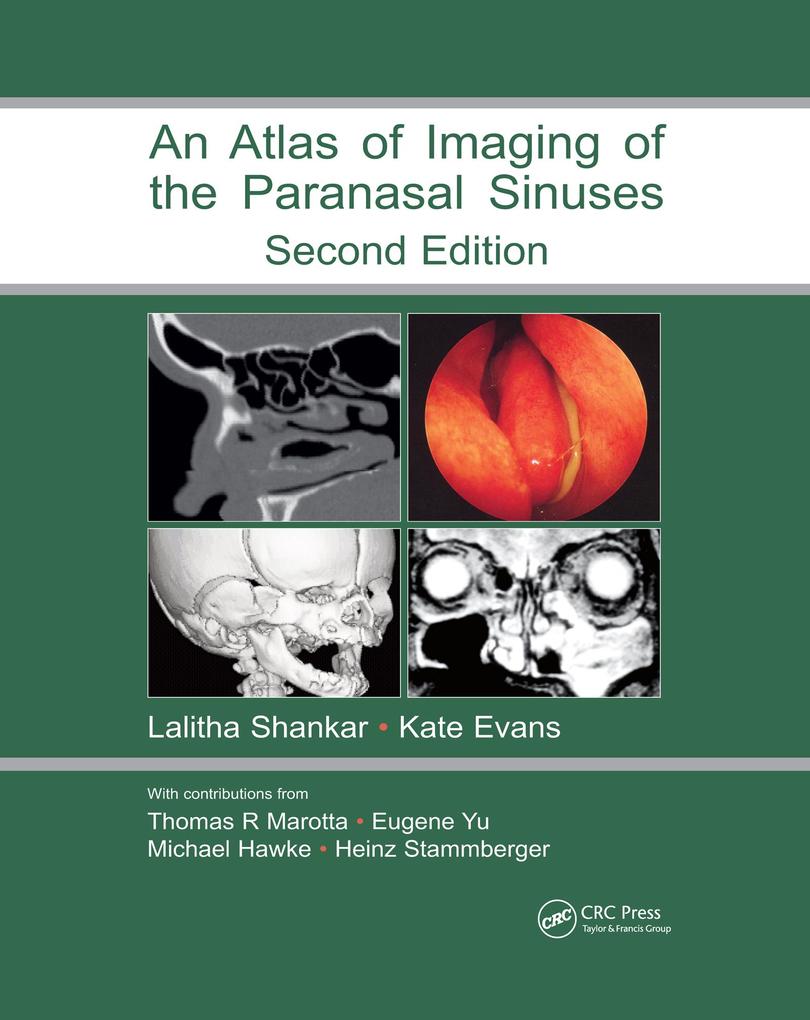 Atlas of Imaging of the Paranasal Sinuses Second Edition