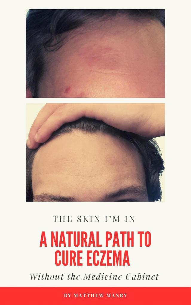 The Skin I‘m In: A Natural Path to Cure Eczema