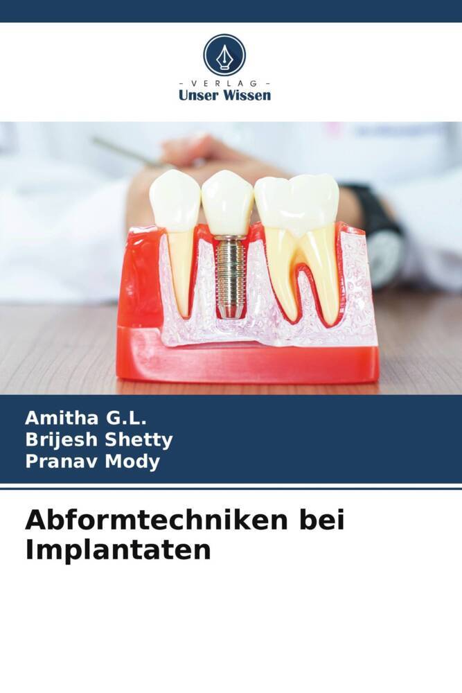 Abformtechniken bei Implantaten