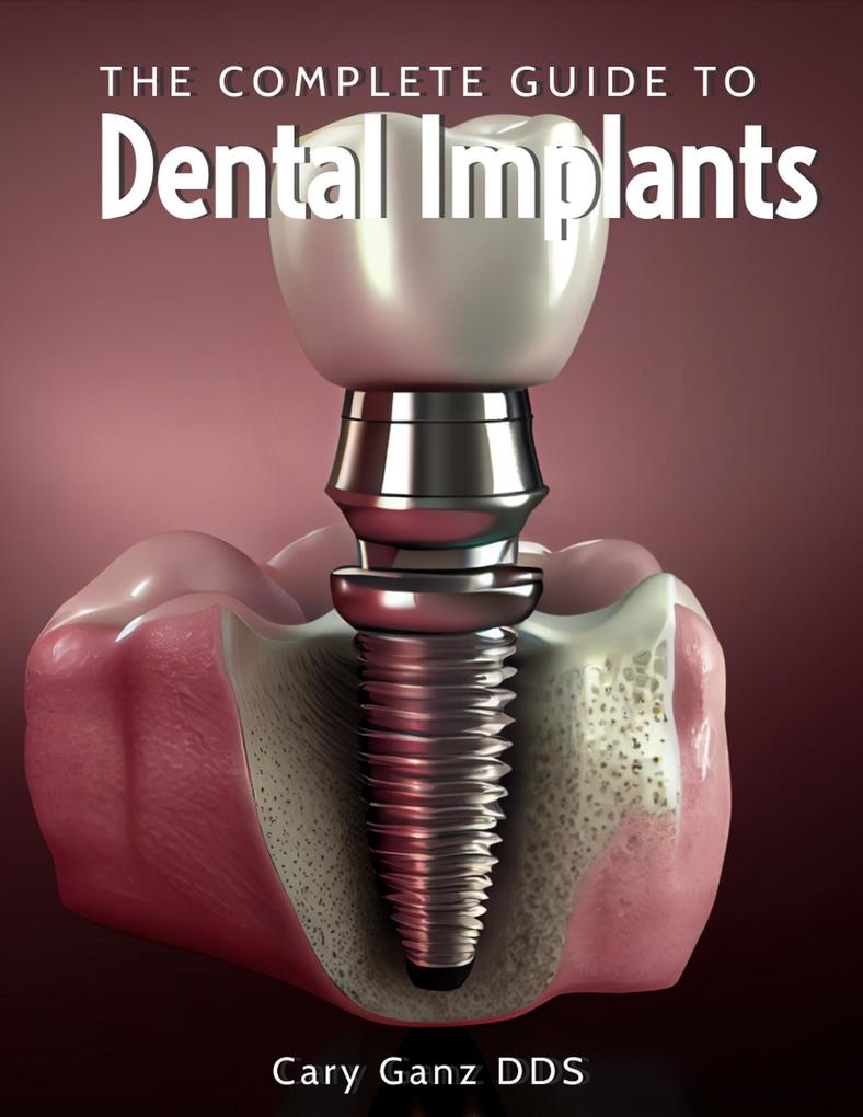 The Complete Guide to Dental Implants (All About Dentistry)