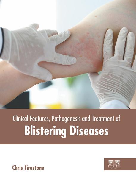 Clinical Features Pathogenesis and Treatment of Blistering Diseases