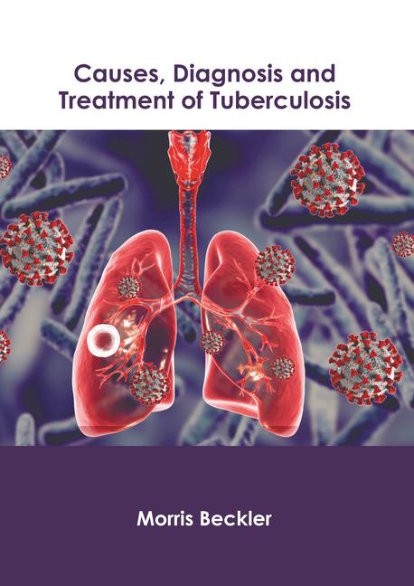 Causes Diagnosis and Treatment of Tuberculosis
