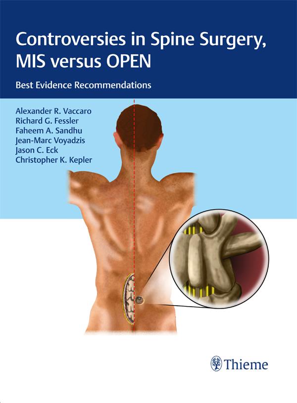 Controversies in Spine Surgery MIS versus OPEN