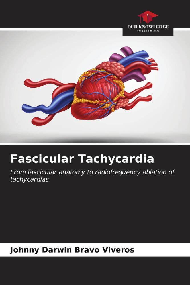 Fascicular Tachycardia