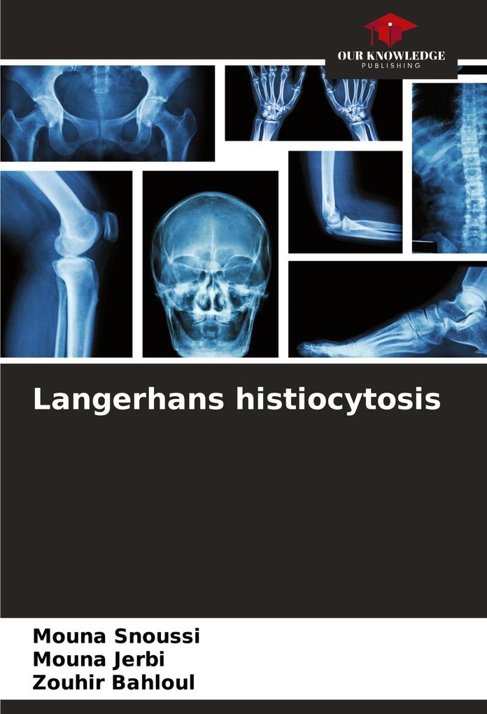 Langerhans histiocytosis
