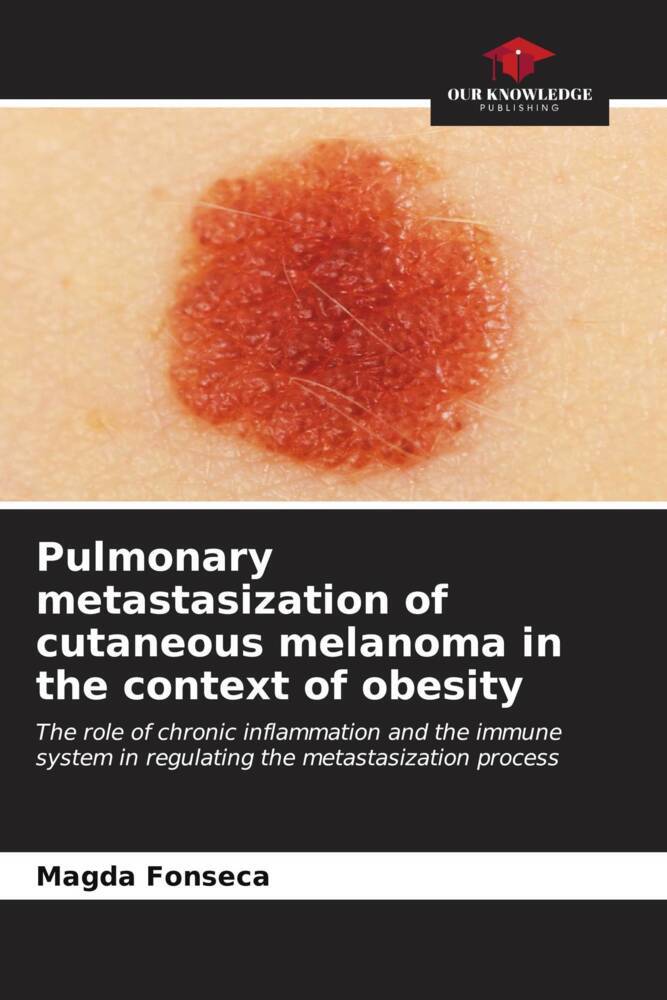Pulmonary metastasization of cutaneous melanoma in the context of obesity