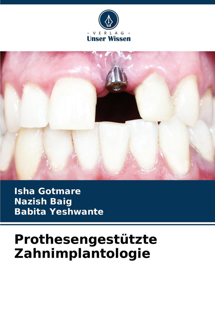 Prothesengestützte Zahnimplantologie