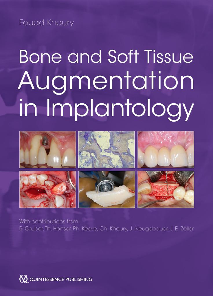 Bone and Soft Tissue Augmentation in Implantology